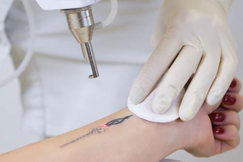 Laser Tattoo removal sessions small/Med size x 3 treatments at Beauty point Med Esthetics